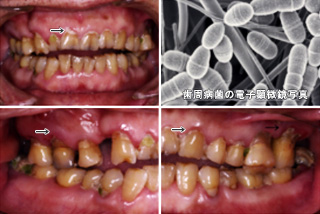 歯と歯ぐきの間に残された歯垢（プラーク）