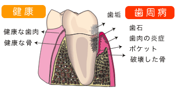 歯周病と全身疾患