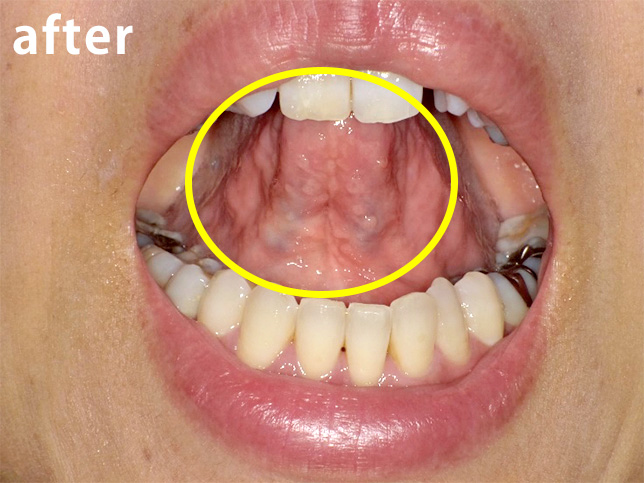 写真：施術後、浮腫みや汚血が取れました