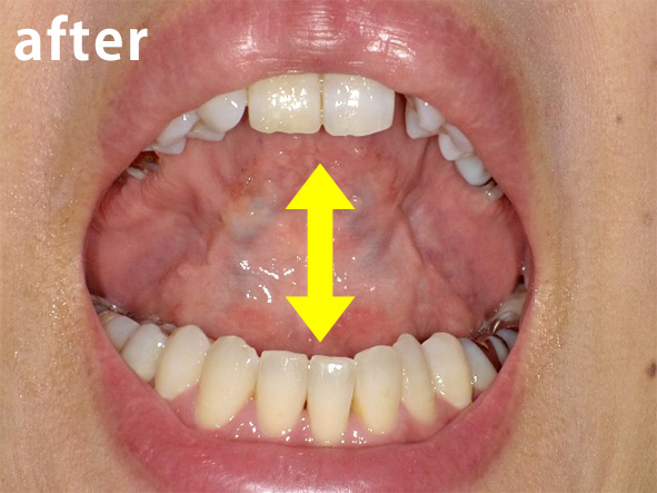 写真：口腔底筋をほぐしたので、舌が上がるようになりました。