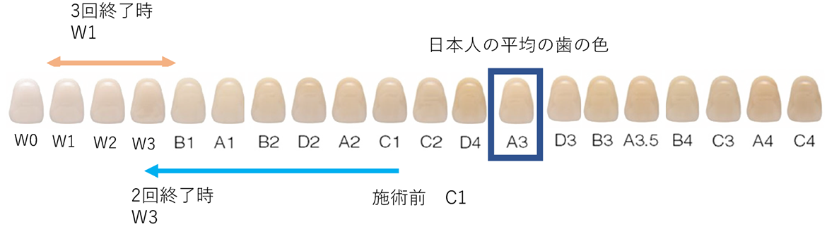 オフィスホワイトニング